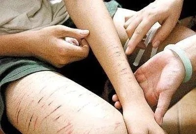 南宁心理咨询 | 一个月内10次自残！青少年「非自杀性自伤」行为背后的心理原因